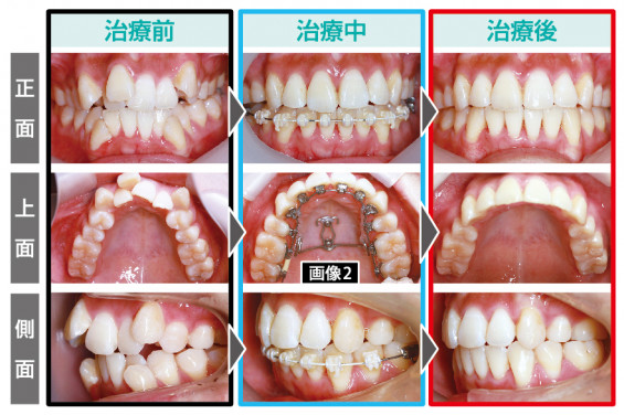 Vol.135 最新の見えない矯正治療 「フルデジタル舌側矯正」 | preko