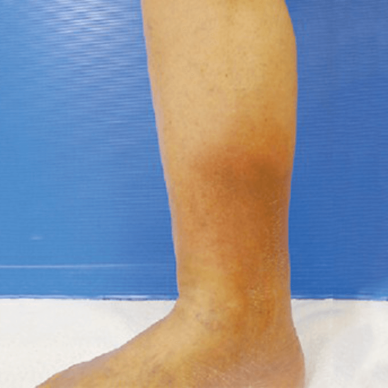 Vol.14 下肢静脈瘤の合併症について④ preko