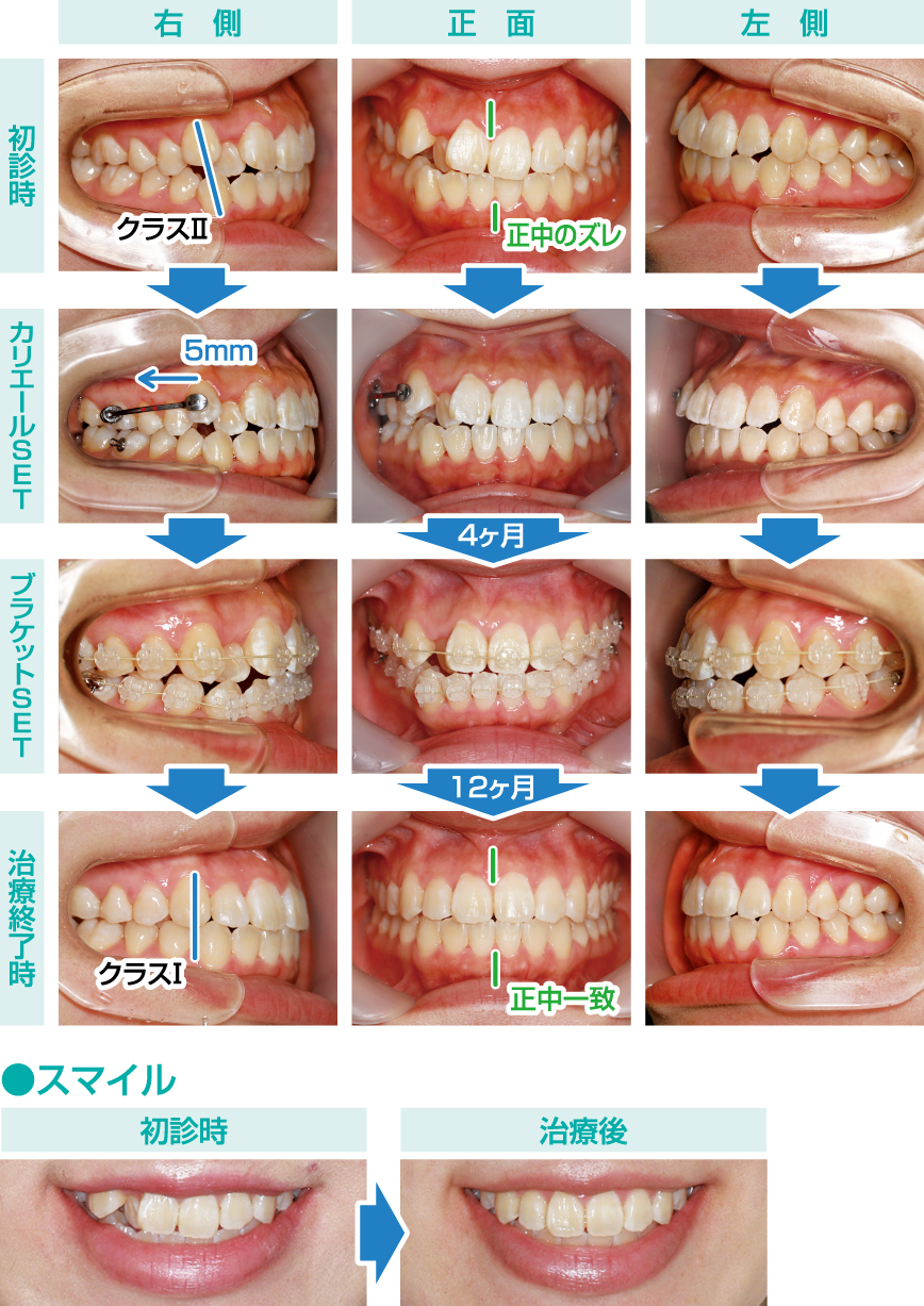 Vol.148 カリエールを用いた 非抜歯矯正治療No.5 | preko