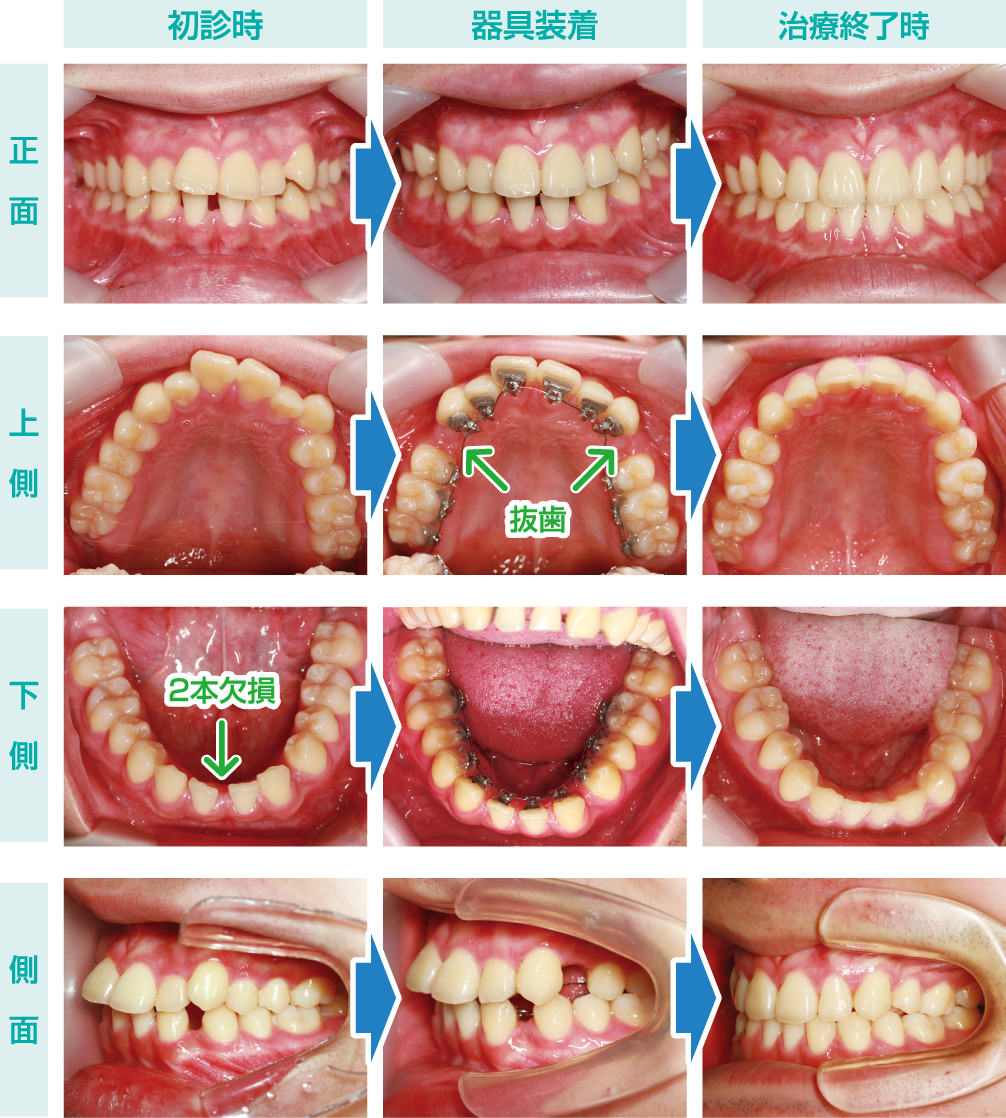Vol.150 先天性欠如歯を伴う矯正治療デジタル舌側矯正 | preko