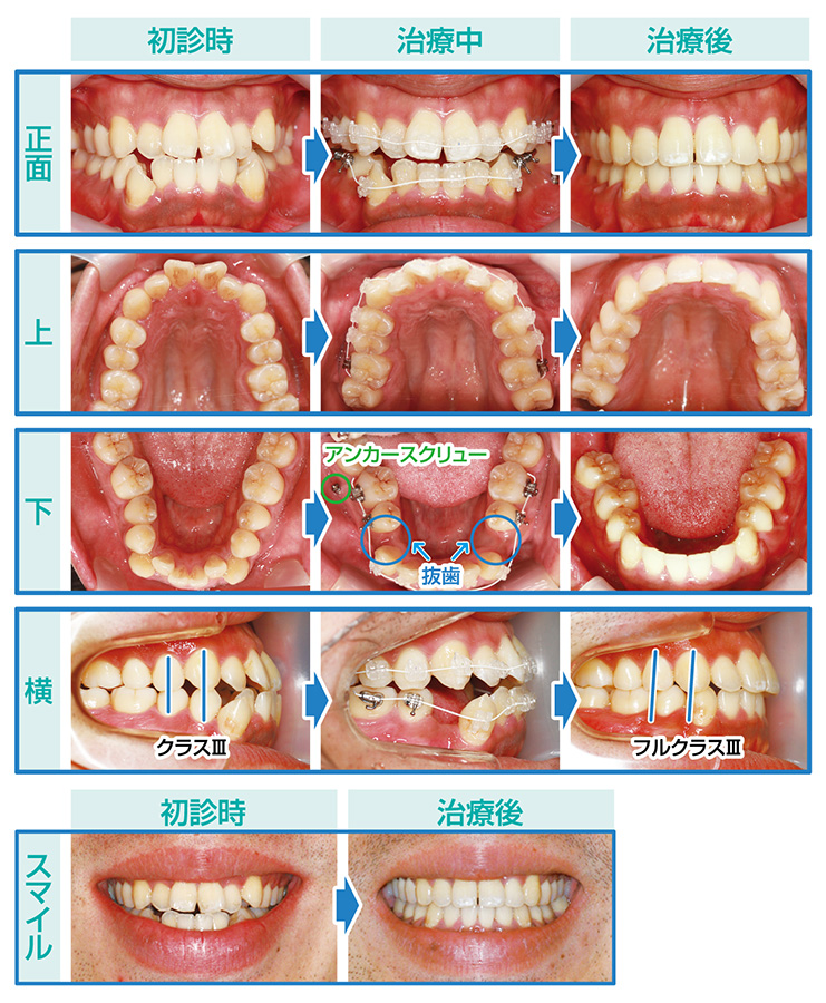 Vol.156 下顎小臼歯抜歯にて治療したクラスIII症例 | preko