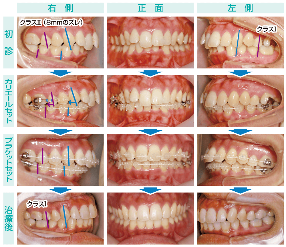 裁断済 機能的咬合構築を目指す 不正咬合の矯正治療 - 健康/医学